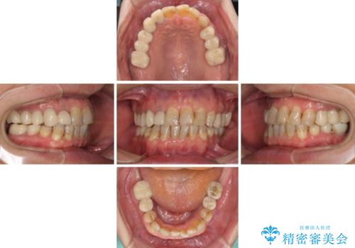 歯列不正と歯周病 総合歯科治療による全顎治療の治療中