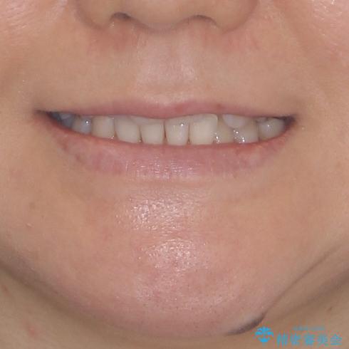 前歯のクロスバイト　インビザライン矯正で改善の治療前（顔貌）