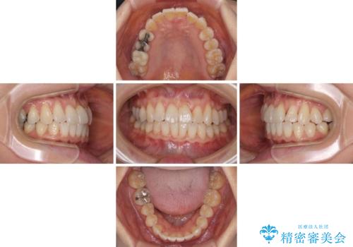 前歯のクロスバイト インビザライン矯正で改善の治療中