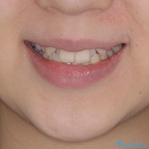 骨格的に左右にずれいている　前歯のデコボコをインビザラインで解消の治療前（顔貌）