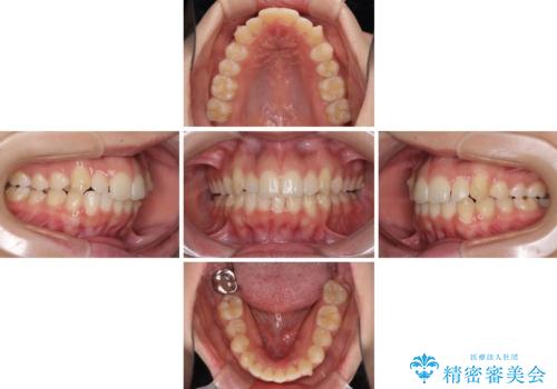 骨格的に左右にずれいている 前歯のデコボコをインビザラインで解消の治療中