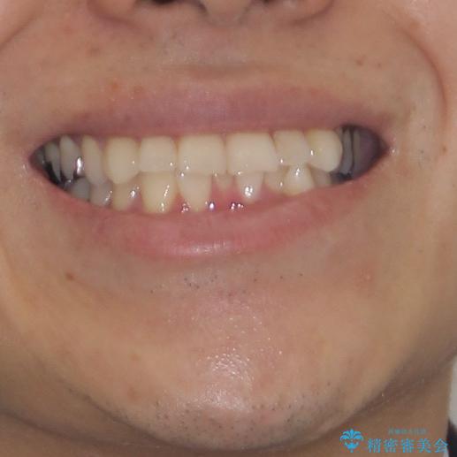 冷たいものがしみて奥歯が痛い 気になる歯並びも治したの治療前(顔貌)