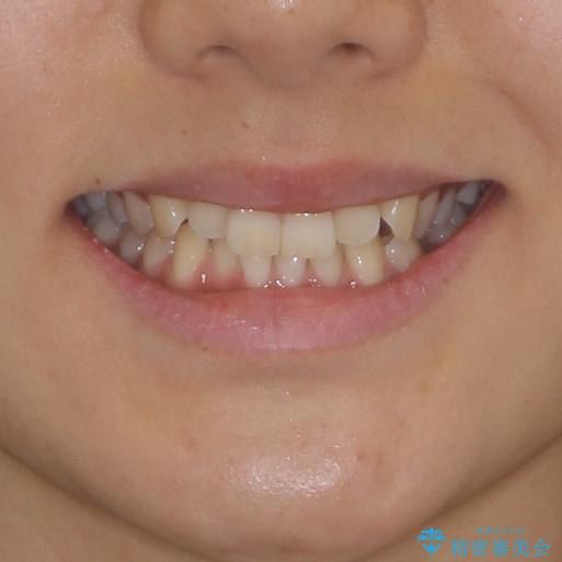 乳歯を抜いてインプラントに 咬み合わせ改善のインビザライン矯正の治療前(顔貌)