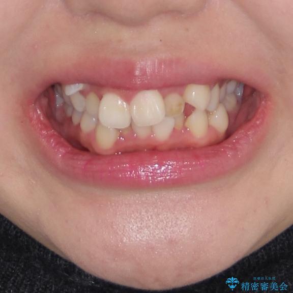 著しい叢生と顎骨のズレ　ワイヤー装置による抜歯矯正の治療前（顔貌）