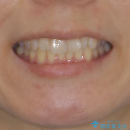 短期間で仕上げたい ワイヤーでの非抜歯矯正の治療前(顔貌)