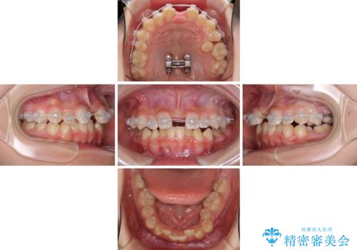 遠方から新幹線で通院 急速拡大装置とインビザラインによる矯正治療の治療中