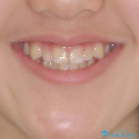 遠方から新幹線で通院 急速拡大装置とインビザラインによる矯正治療の治療前(顔貌)