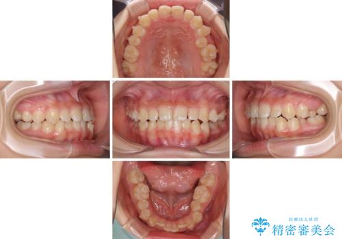 遠方から新幹線で通院 急速拡大装置とインビザラインによる矯正治療の治療中