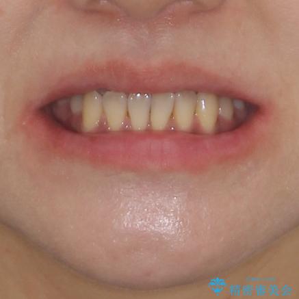 反対咬合で痛む前歯を改善　インビザラインによる矯正治療の治療前（顔貌）