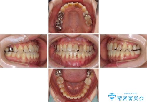 反対咬合で痛む前歯を改善 インビザラインによる矯正治療の治療中