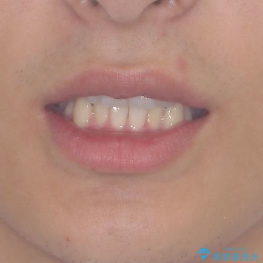 狭い歯列と前歯のデコボコ　インビザラインによる矯正治療の治療前（顔貌）