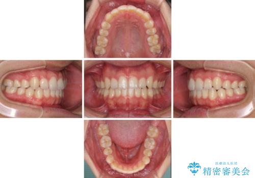 狭い歯列と前歯のデコボコ　インビザラインによる矯正治療の治療中