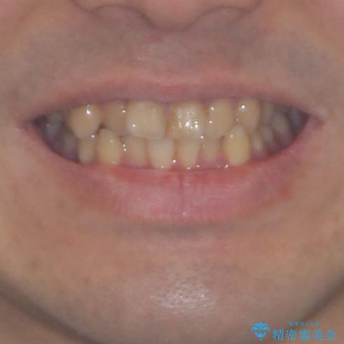 歯列全体のクロスバイトを治したい　ワイヤー装置による矯正治療の治療前（顔貌）