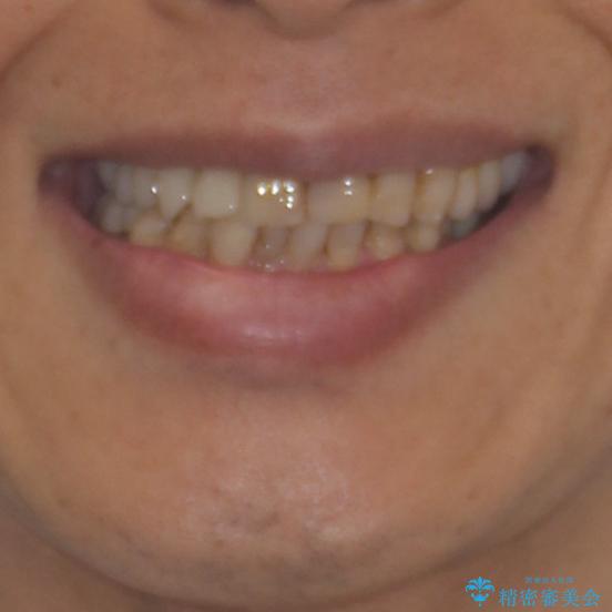 歯列不正と歯周病　総合歯科治療による全顎治療の治療前（顔貌）