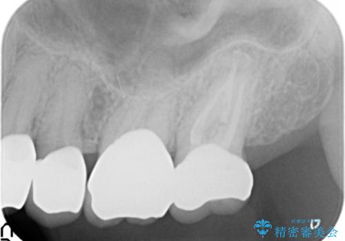 奥歯の被せ物のやり直し　精密根管治療の治療後