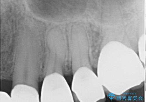 奥歯の被せ物のやり直し　精密根管治療の治療後