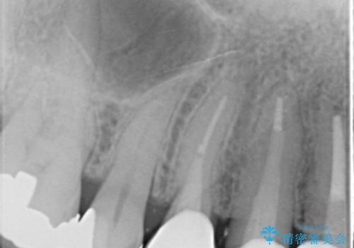 前歯のブリッジの下が虫歯 ブリッジのやりかえの治療後