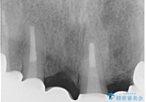 前歯のブリッジの下が虫歯 ブリッジのやりかえの治療後