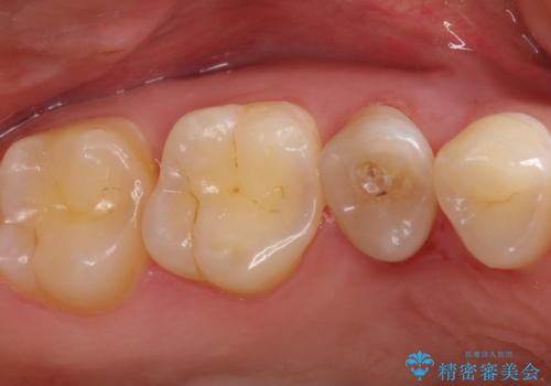【中心結節破折】MTAセメントを用いたアペキシフィケーションの治療前