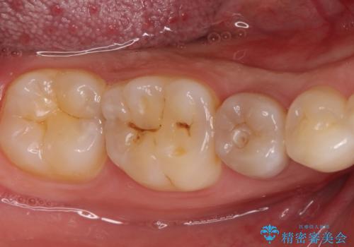 【サイナストラクト】歯肉に膿の出口がある歯の治療の治療前