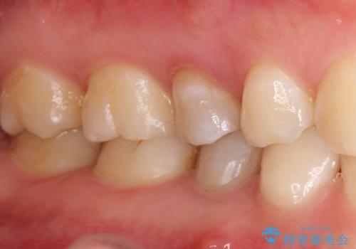 【サイナストラクト】歯肉に膿の出口がある歯の治療の治療前