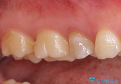 【中心結節破折】MTAセメントを用いたアペキシフィケーションの治療前