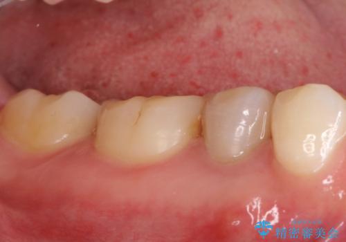 【サイナストラクト】歯肉に膿の出口がある歯の治療の治療前