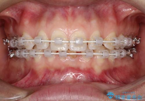 【空隙歯列】ワイヤー矯正で短期間に治療を終えたいの治療中