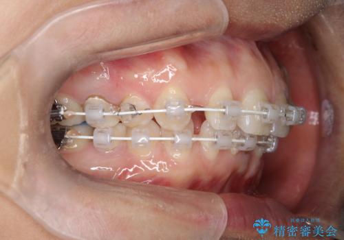 【空隙歯列】ワイヤー矯正で短期間に治療を終えたいの治療中