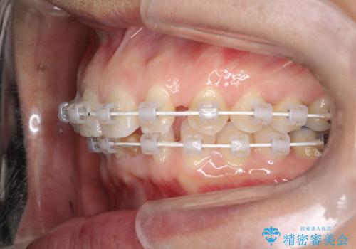 【空隙歯列】ワイヤー矯正で短期間に治療を終えたいの治療中