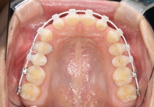 【空隙歯列】ワイヤー矯正で短期間に治療を終えたいの治療中