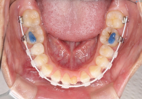 【空隙歯列】ワイヤー矯正で短期間に治療を終えたいの治療中