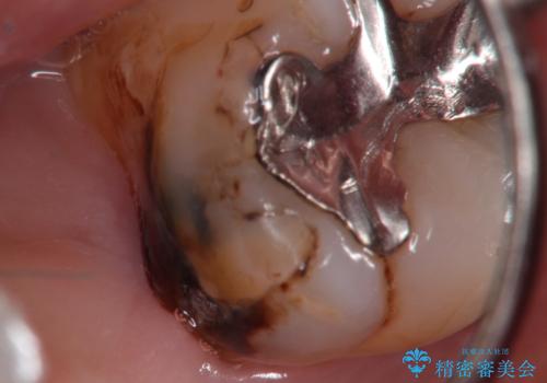 メタルボンドクラウンによる虫歯の治療