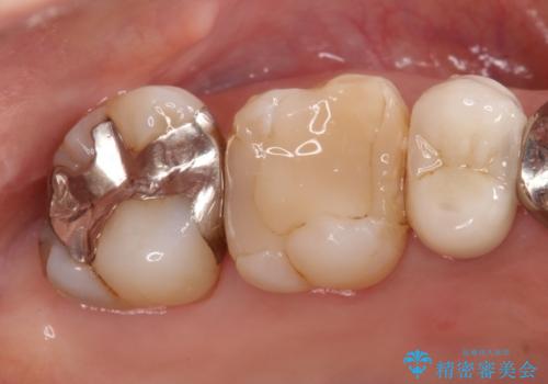 メタルボンドクラウンによる虫歯の治療の治療前