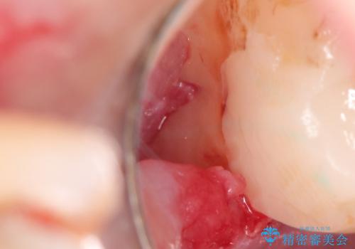 メタルボンドクラウンによる虫歯の治療の治療後