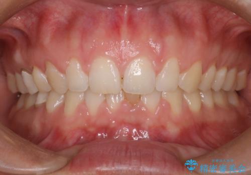 【前歯ブリッジ】下顎前歯の先天性欠如の補綴治療の治療前