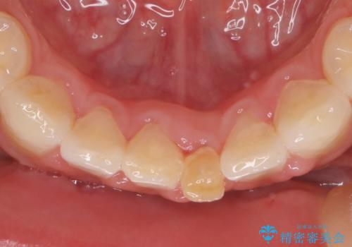 【前歯ブリッジ】下顎前歯の先天性欠如の補綴治療の治療前