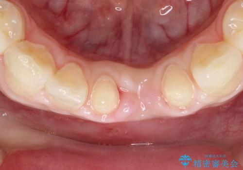 【前歯ブリッジ】下顎前歯の先天性欠如の補綴治療の治療中