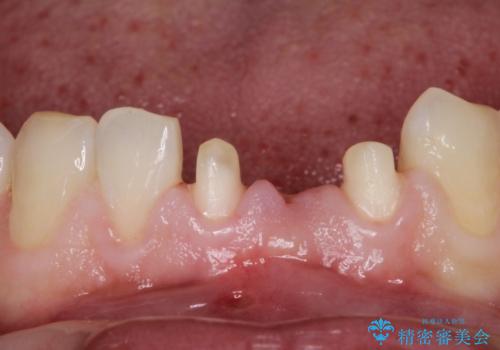 【前歯ブリッジ】下顎前歯の先天性欠如の補綴治療の治療中