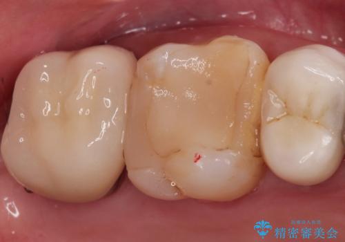 メタルボンドクラウンによる虫歯の治療の治療後