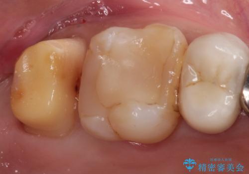 メタルボンドクラウンによる虫歯の治療の治療中