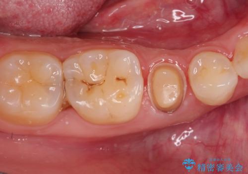【サイナストラクト】歯肉に膿の出口がある歯の治療の治療中