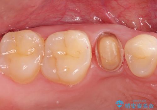 【中心結節破折】MTAセメントを用いたアペキシフィケーションの治療中