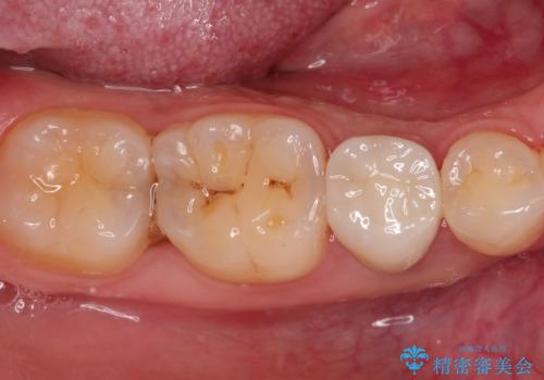 【サイナストラクト】歯肉に膿の出口がある歯の治療の治療後