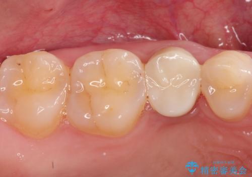 【中心結節破折】MTAセメントを用いたアペキシフィケーションの治療後