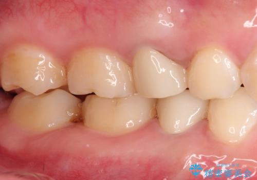 【サイナストラクト】歯肉に膿の出口がある歯の治療の治療後