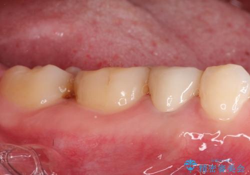 【サイナストラクト】歯肉に膿の出口がある歯の治療の治療後