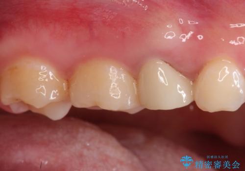 【中心結節破折】MTAセメントを用いたアペキシフィケーションの治療後