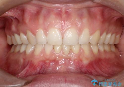 【空隙歯列】ワイヤー矯正で短期間に治療を終えたいの治療後