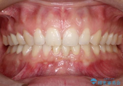 【前歯ブリッジ】下顎前歯の先天性欠如の補綴治療の治療後
